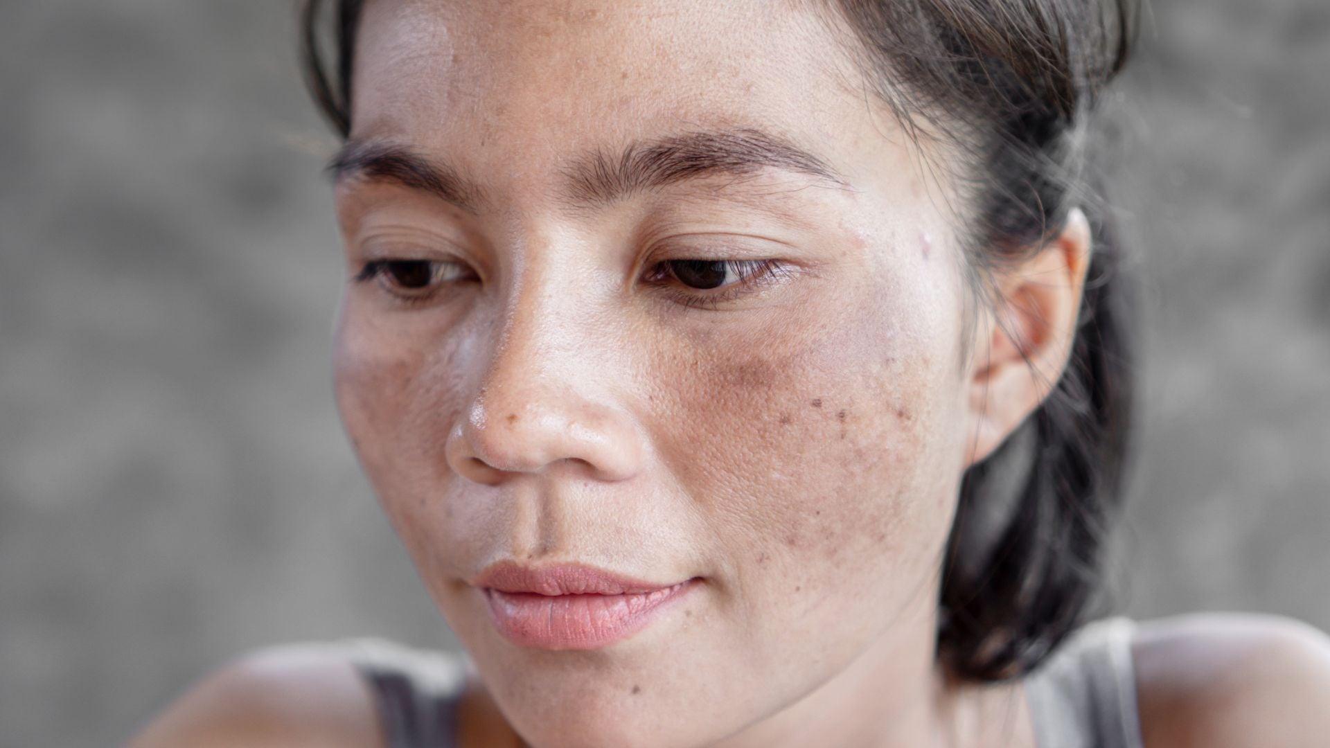Top 10 Coix Seed Benefits for Skin