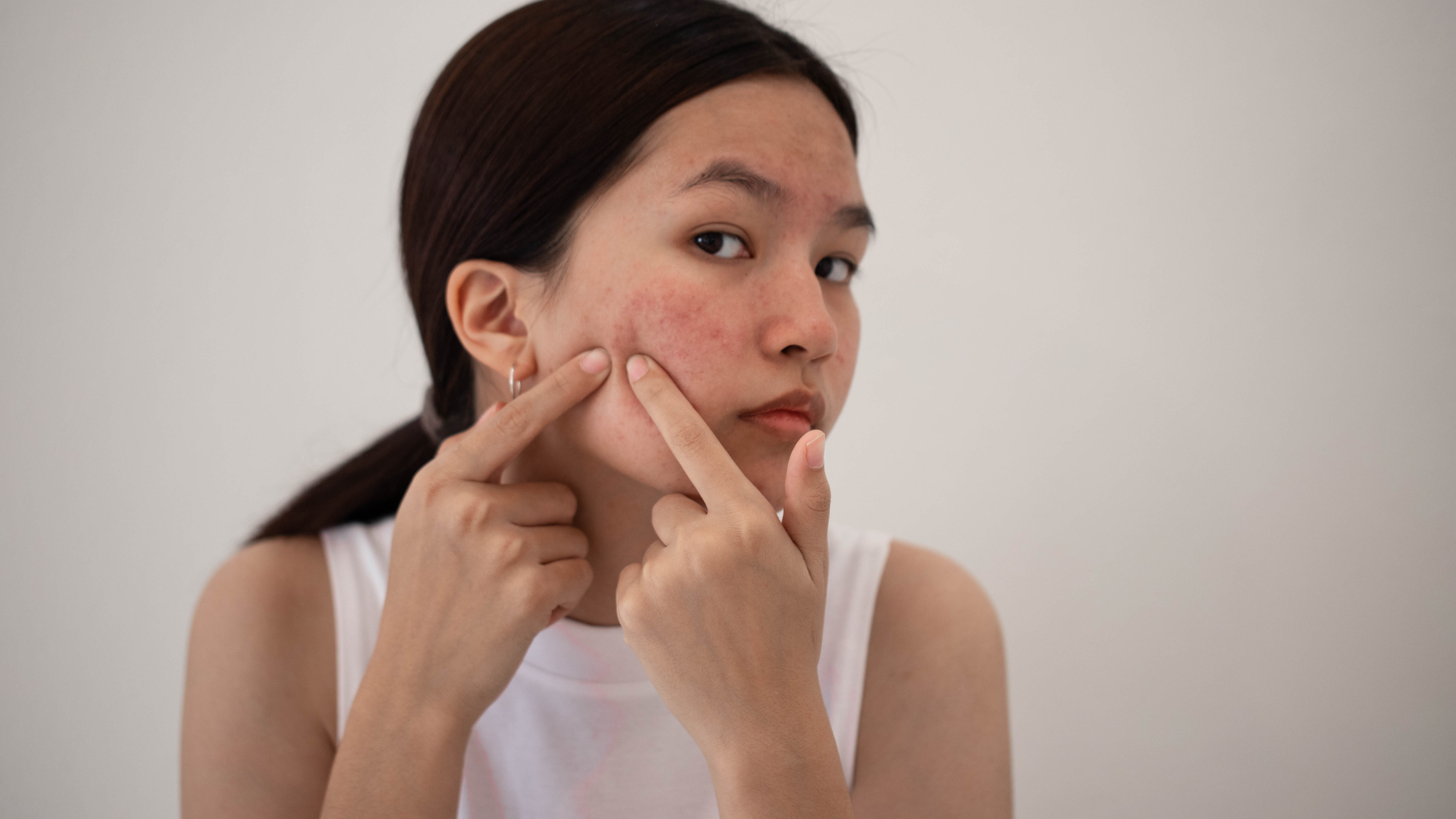How Probiotics Can Help You Rid of Acne and Achieve Clearer Skin