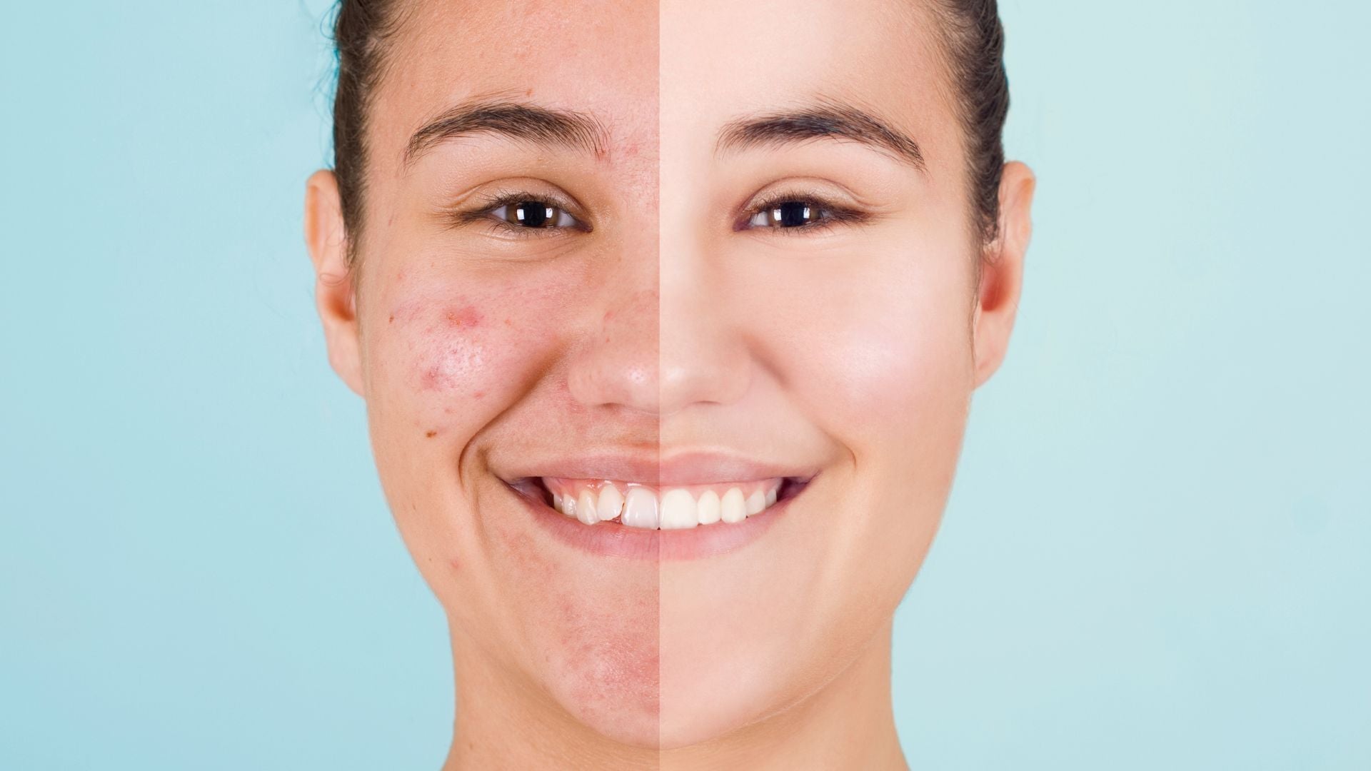 Coix Seed for Acne: A Natural Solution for Clearer, Healthier Skin