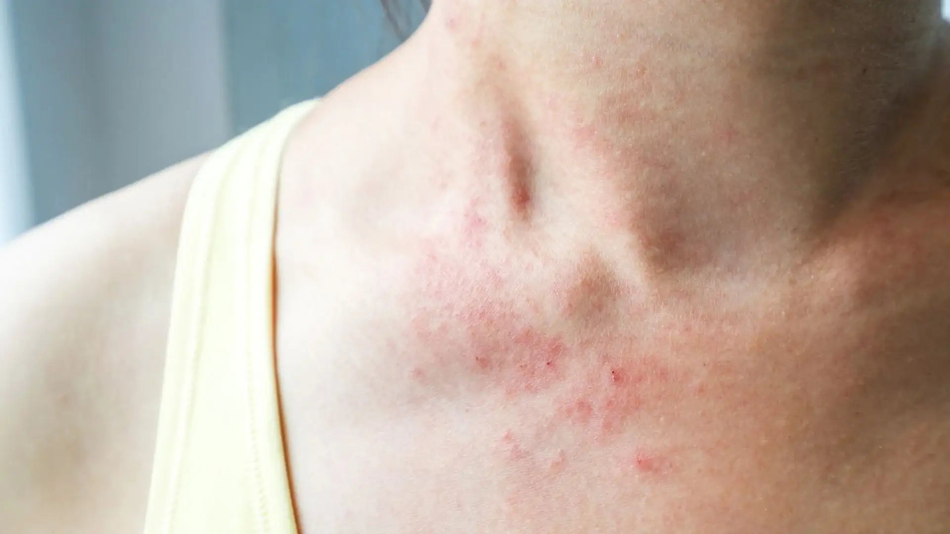 Natural Eczema Relief: How Coix Seed Extract Can Calm and Soothe Your Skin - Crane Wellness